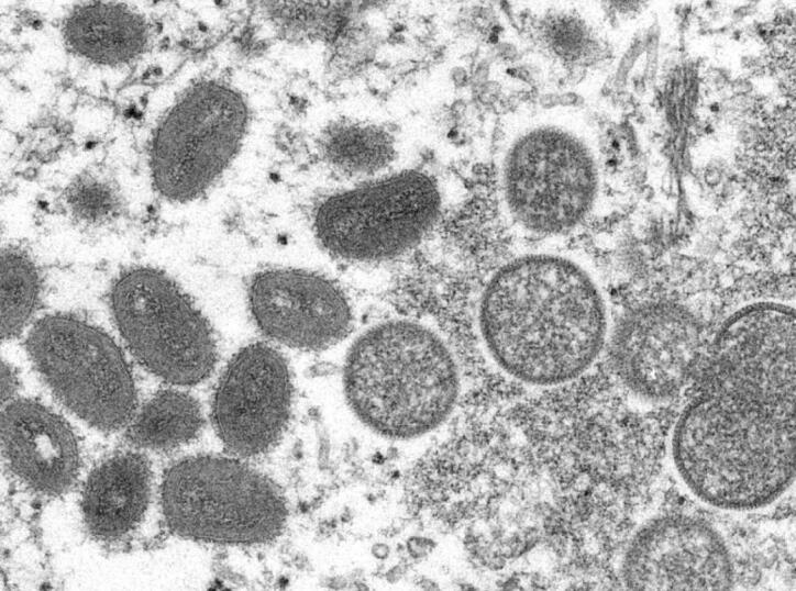 西班牙出現兩宗同猴痘相關死亡 仍需確定直接死因